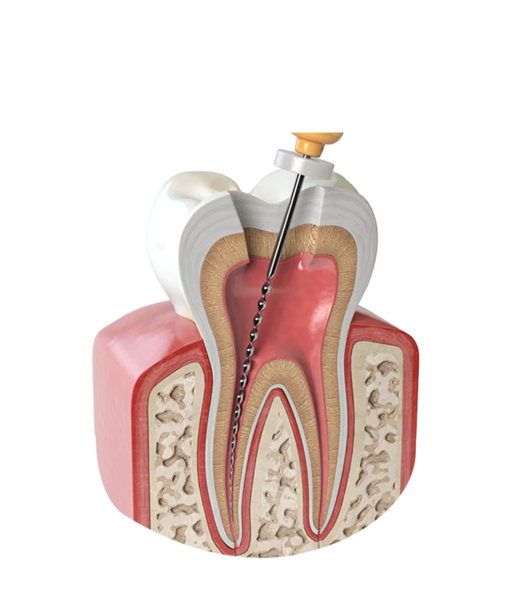 https://radiance.al/wp-content/uploads/2024/10/Endodontics-up-1.png