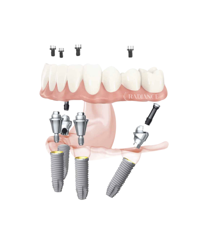 Trattamento All on 4 per la riabilitazione di un’intera arcata dentale con impianti.