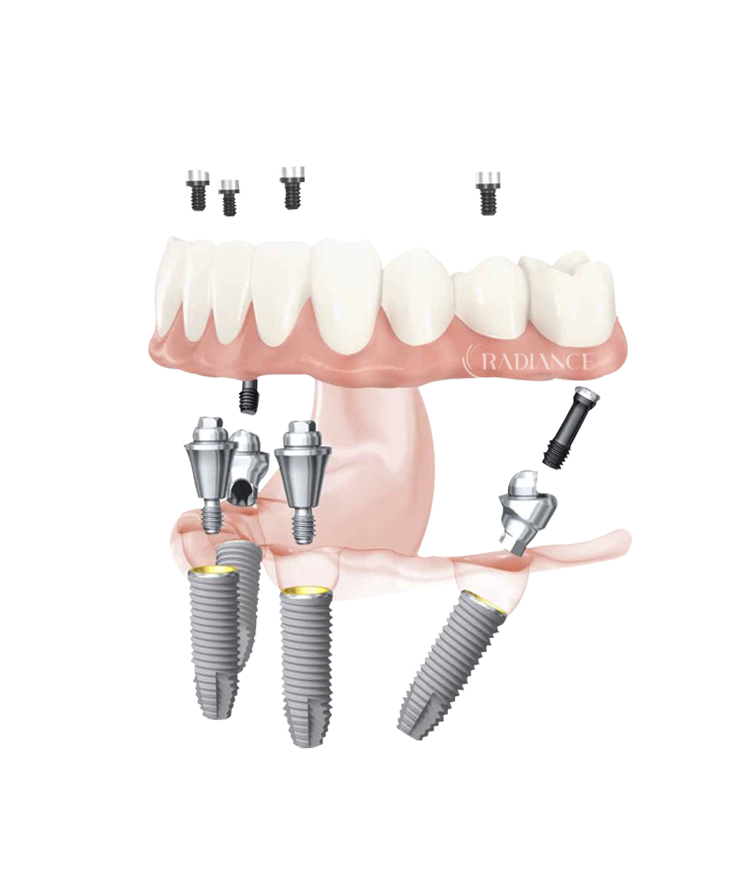 Trattamento All on 4 per la riabilitazione di un’intera arcata dentale con impianti.