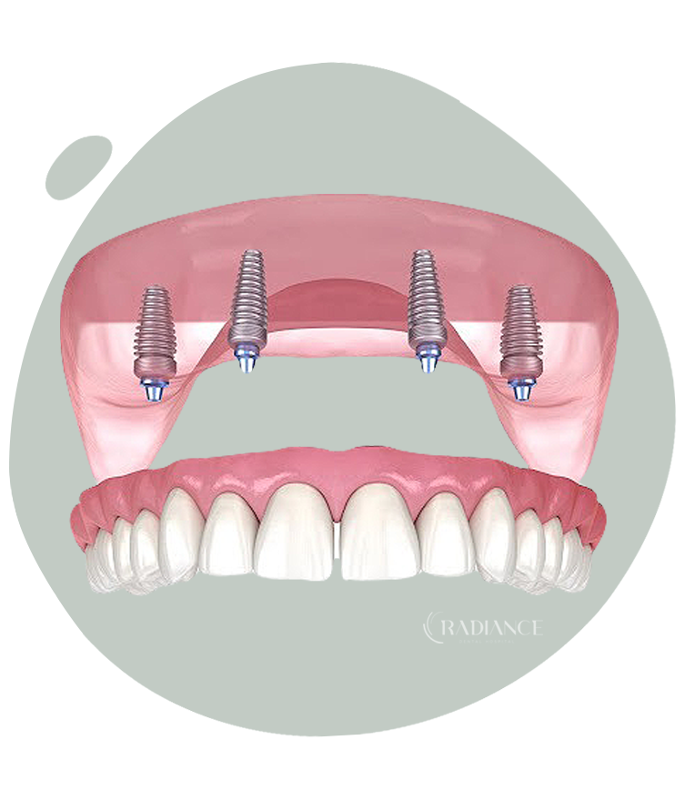 Trattamento All on 4 per la riabilitazione di un’intera arcata dentale con impianti.