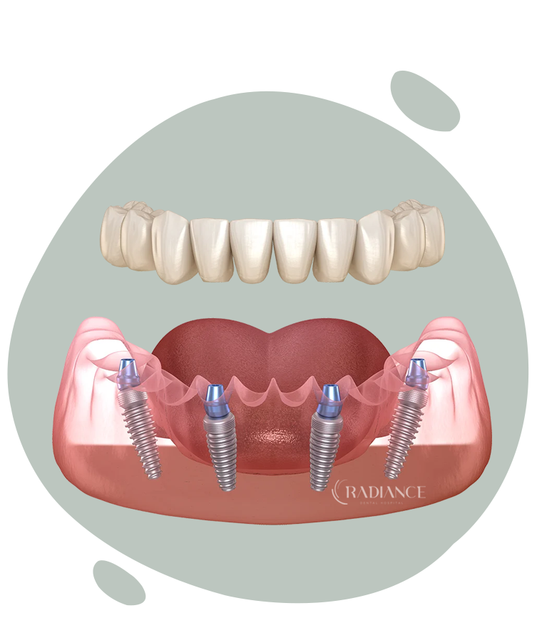 Trattamento All on 4 per la riabilitazione di un’intera arcata dentale con impianti.