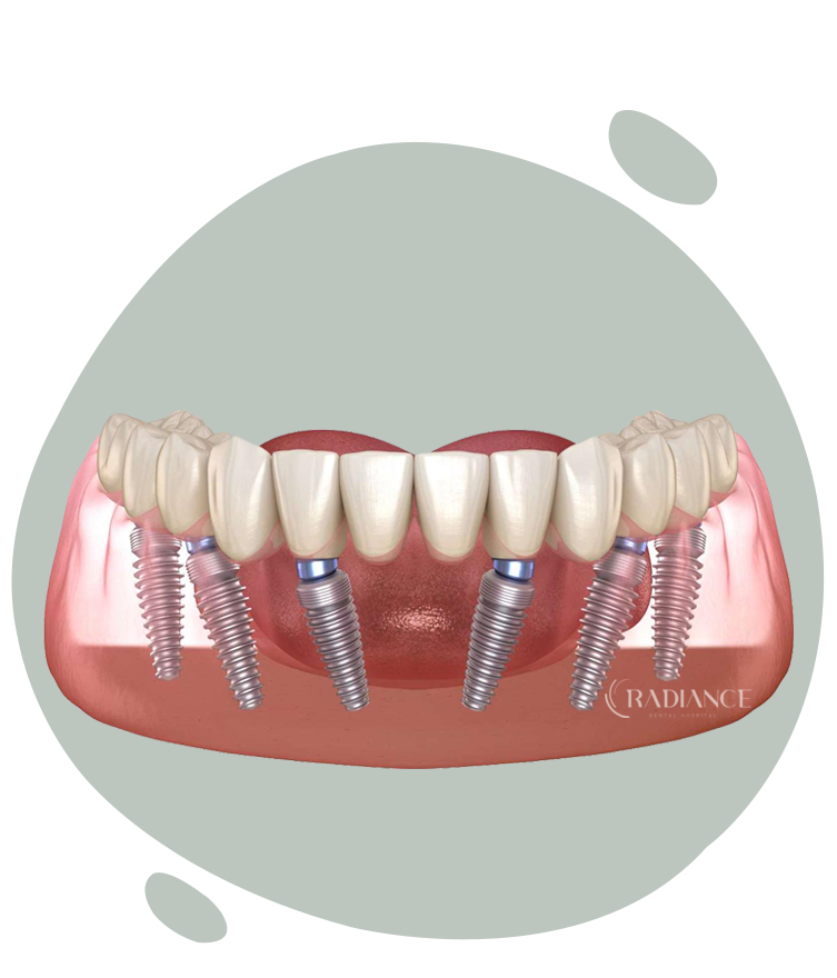 Trattamento dentale All on 6 con sei impianti per una dentatura stabile.