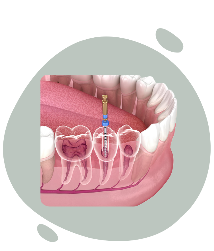 https://radiance.al/wp-content/uploads/2024/10/endodontics_2-1.png