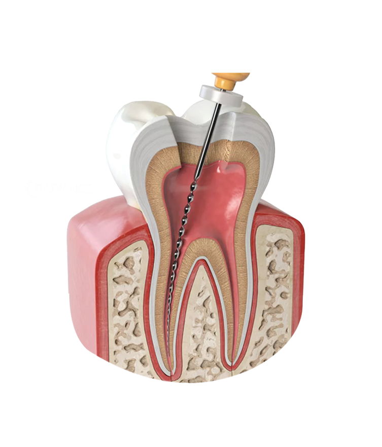 Dentista che esegue un trattamento endodontico su un paziente.