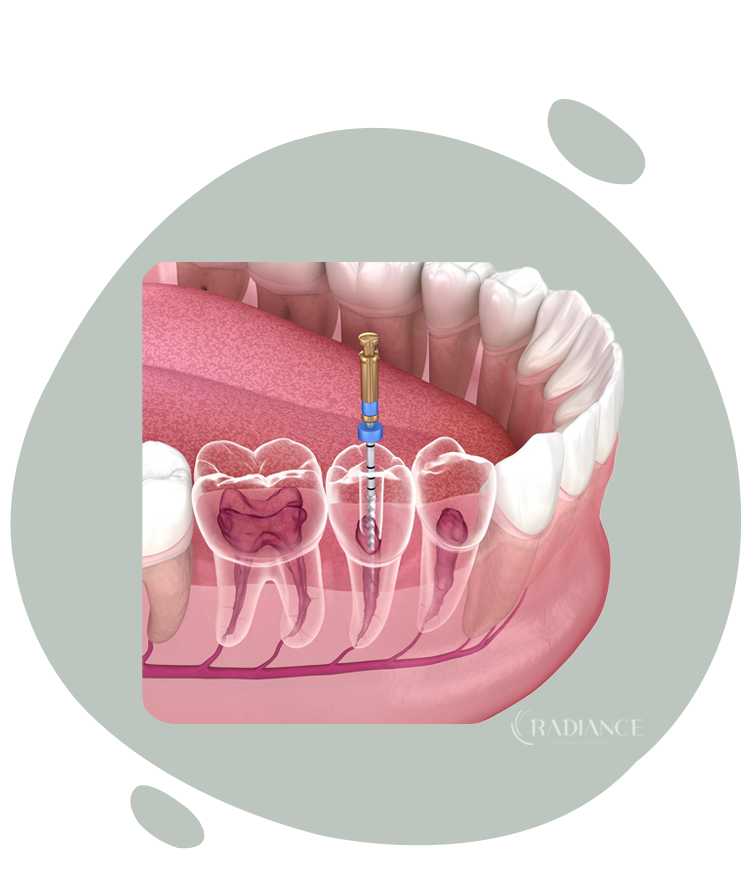 Dentista che esegue un trattamento endodontico su un paziente.