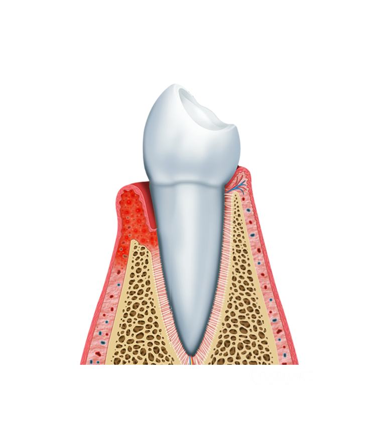 Dentista che esegue un trattamento parodontale su un paziente.