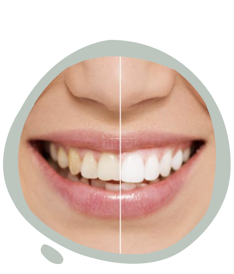 https://radiance.al/wp-content/uploads/2024/10/teeth_whitening_2.png