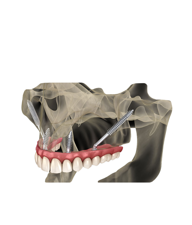 https://radiance.al/wp-content/uploads/2024/10/zygomatic_dental_implants.png