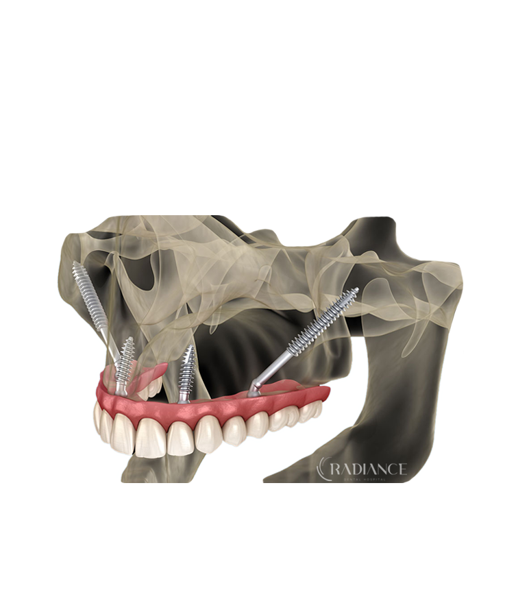 Trattamento con impianti zigomatici per la riabilitazione dentale.